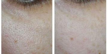 Visa och berätta hur bruket för porerna på huden 50+